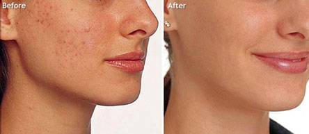 resultat peeling au pontet proche des angles l