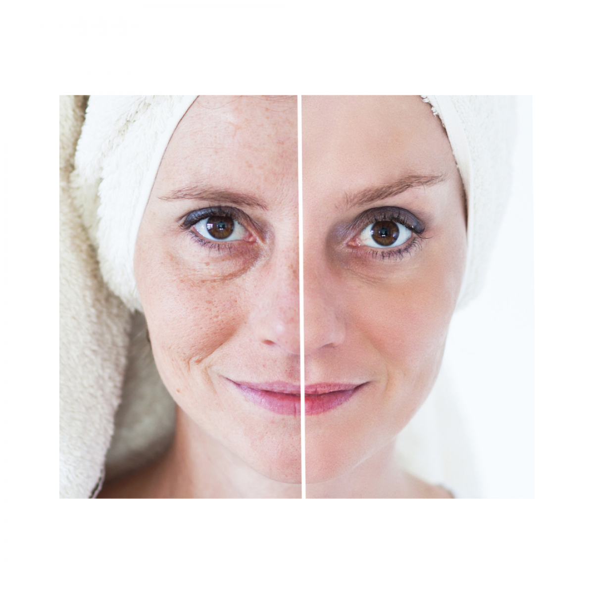 Microneedling anti-age Le pontet