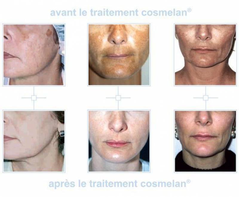 Traitementcosmelan anti tache sur avignon vaucluse