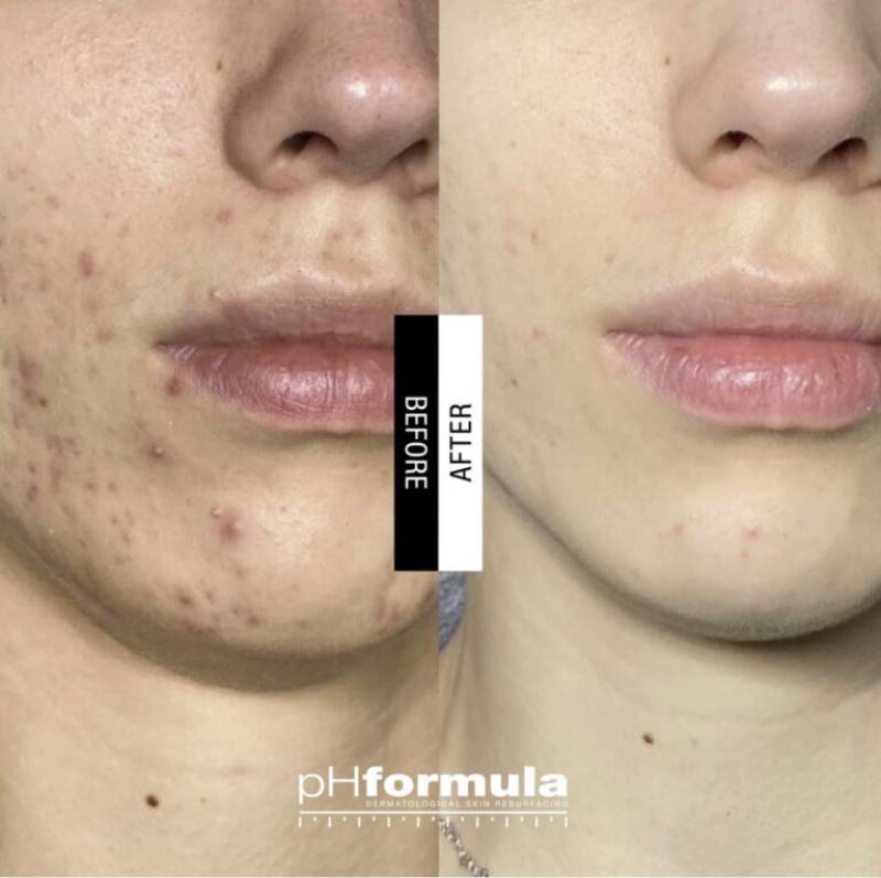 peeling acne avignon