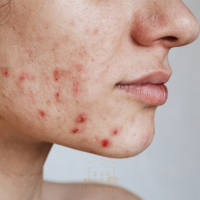 Notre zone d'activité pour ce service Salon de beauté pour traitement de l'acné hormonale